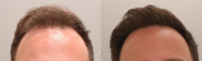 FUT Case 1001888 Before & After Front | Serving Rochester, Syracuse & Buffalo, NY | Quatela Center for Plastic Surgery