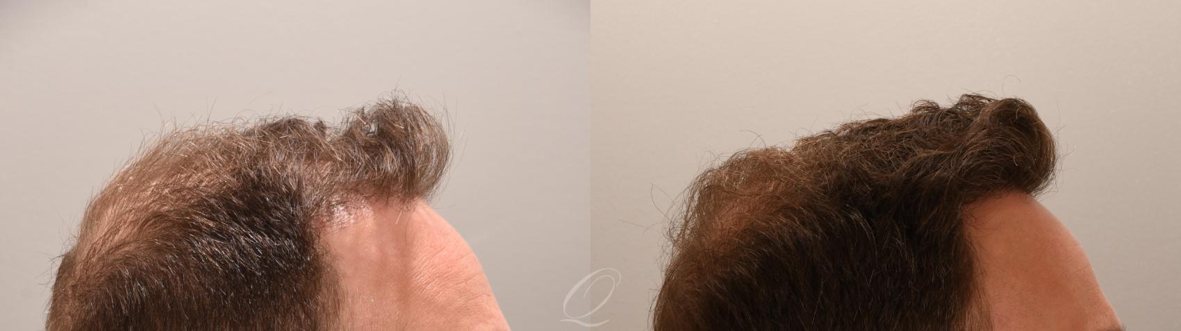FUT Case 1001888 Before & After Left Oblique | Serving Rochester, Syracuse & Buffalo, NY | Quatela Center for Plastic Surgery