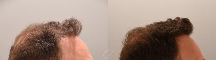 FUT Case 1001888 Before & After Left Oblique | Serving Rochester, Syracuse & Buffalo, NY | Quatela Center for Plastic Surgery