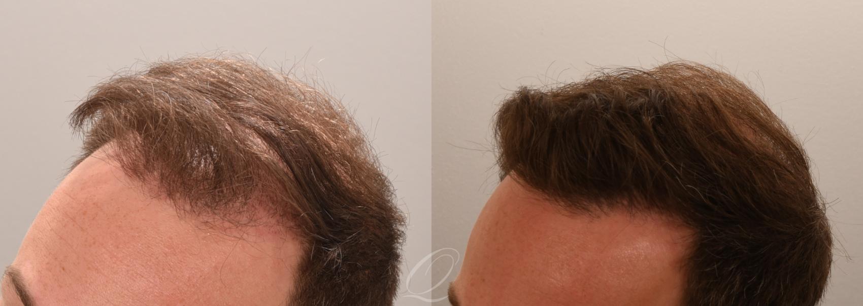 FUT Case 1001888 Before & After Left Side | Serving Rochester, Syracuse & Buffalo, NY | Quatela Center for Plastic Surgery