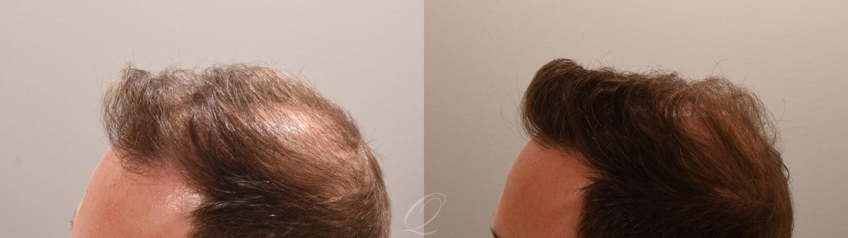 FUT Case 1001888 Before & After Right Oblique | Serving Rochester, Syracuse & Buffalo, NY | Quatela Center for Plastic Surgery