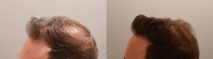 FUT Case 1001888 Before & After Right Oblique | Serving Rochester, Syracuse & Buffalo, NY | Quatela Center for Plastic Surgery