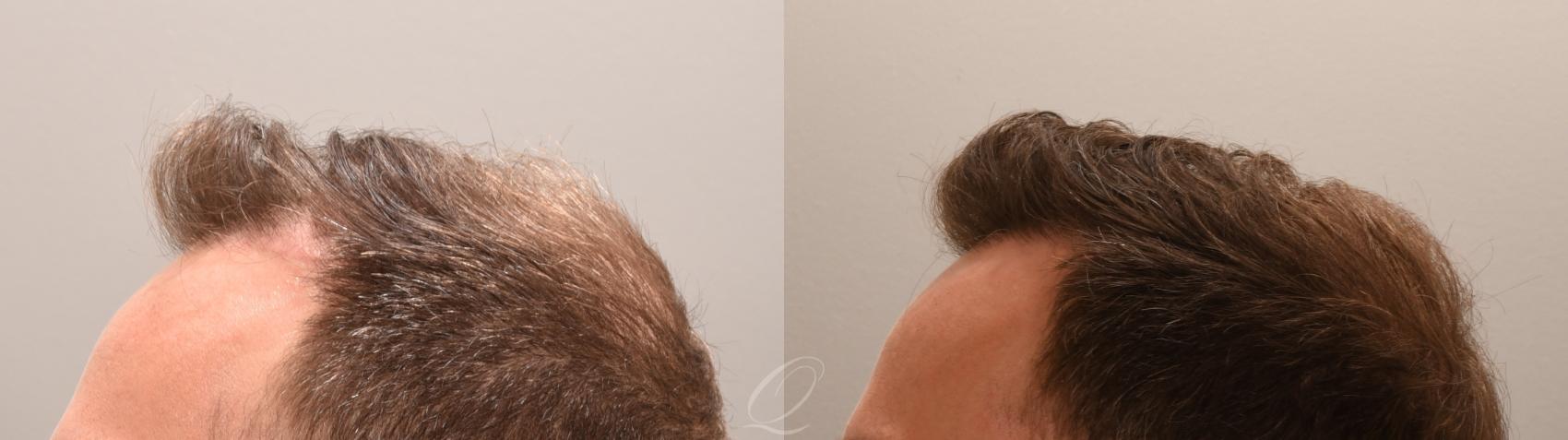 FUT Case 1001888 Before & After Right Side | Serving Rochester, Syracuse & Buffalo, NY | Quatela Center for Plastic Surgery