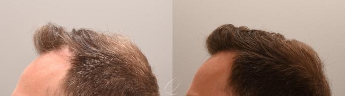 FUT Case 1001888 Before & After Right Side | Serving Rochester, Syracuse & Buffalo, NY | Quatela Center for Plastic Surgery
