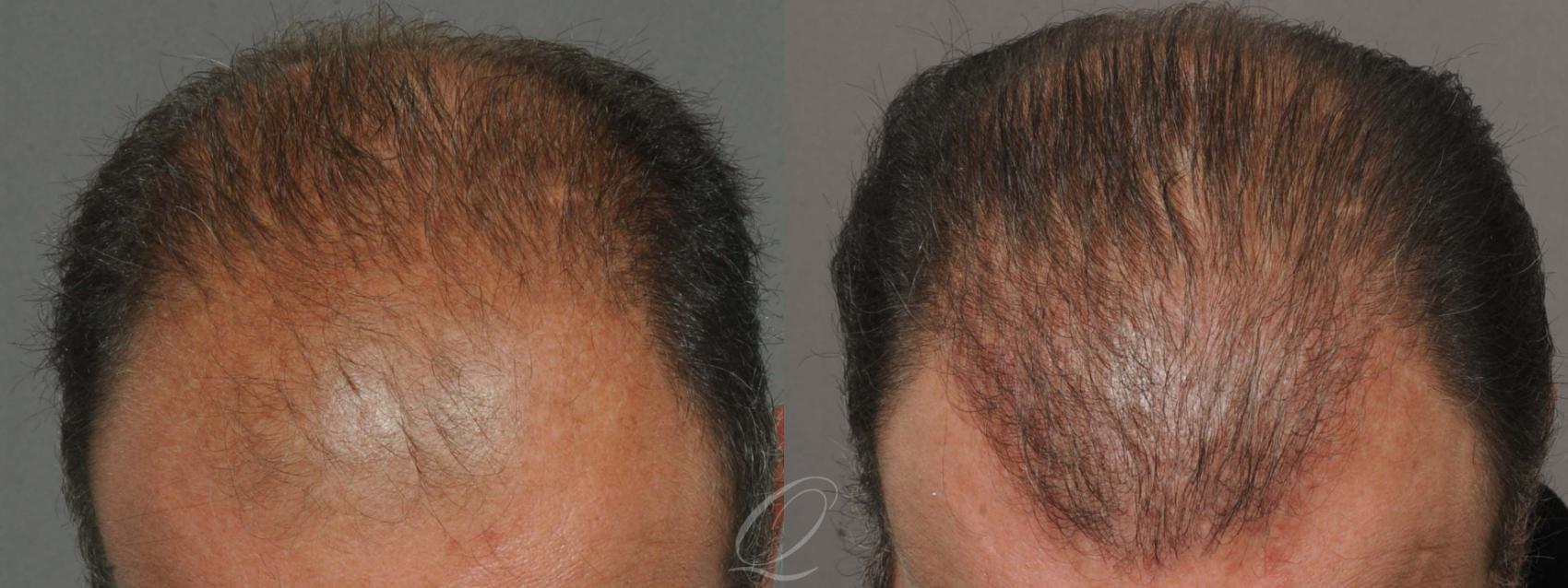 Male Hairline and Central Density Hair Restoration Case 1010 Before & After View #1 | Serving Rochester, Syracuse & Buffalo, NY | Quatela Center for Plastic Surgery