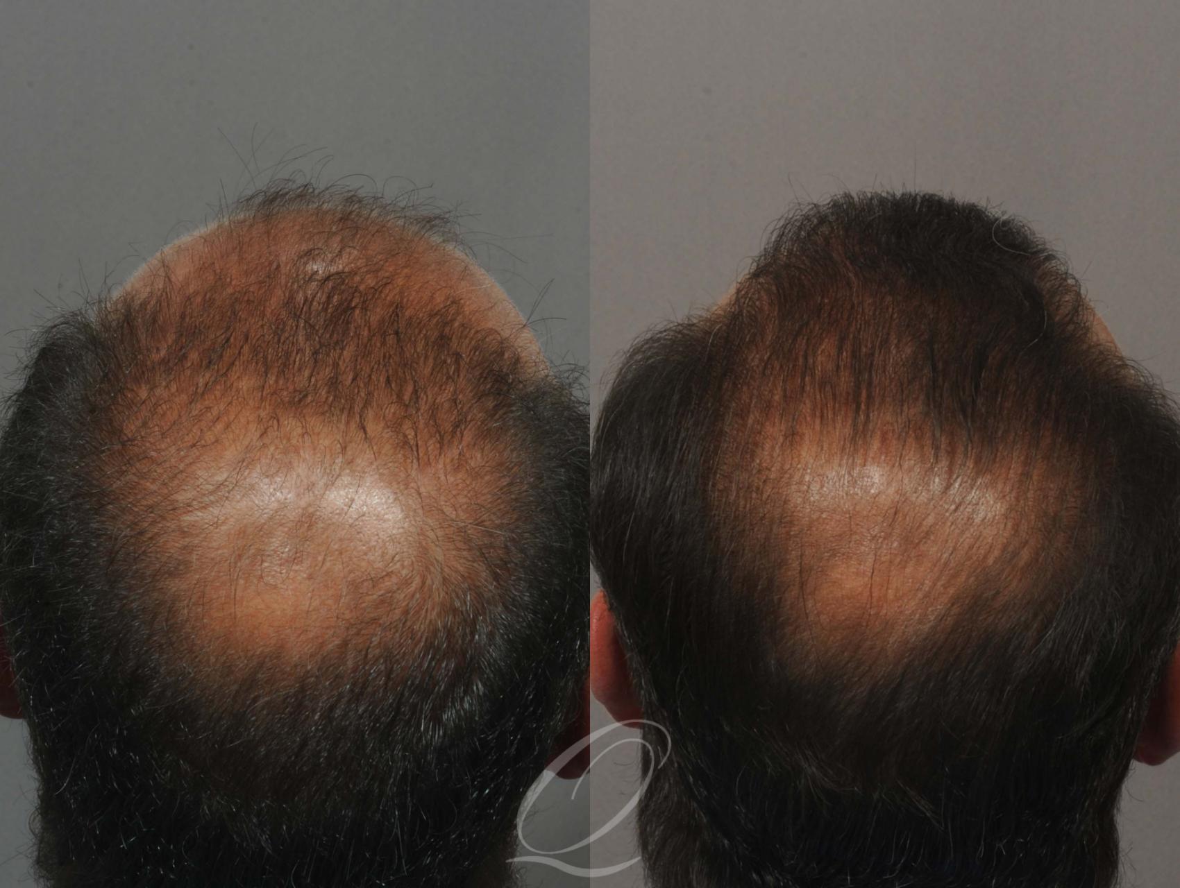 FUT Case 1010 Before & After View #3 | Rochester, Buffalo, & Syracuse, NY | Quatela Center for Hair Restoration