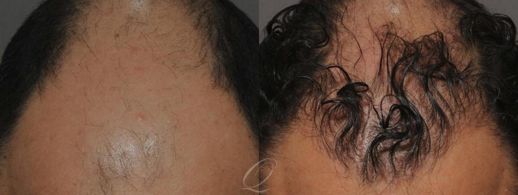 FUT Case 1011 Before & After View #1 | Rochester, Buffalo, & Syracuse, NY | Quatela Center for Hair Restoration