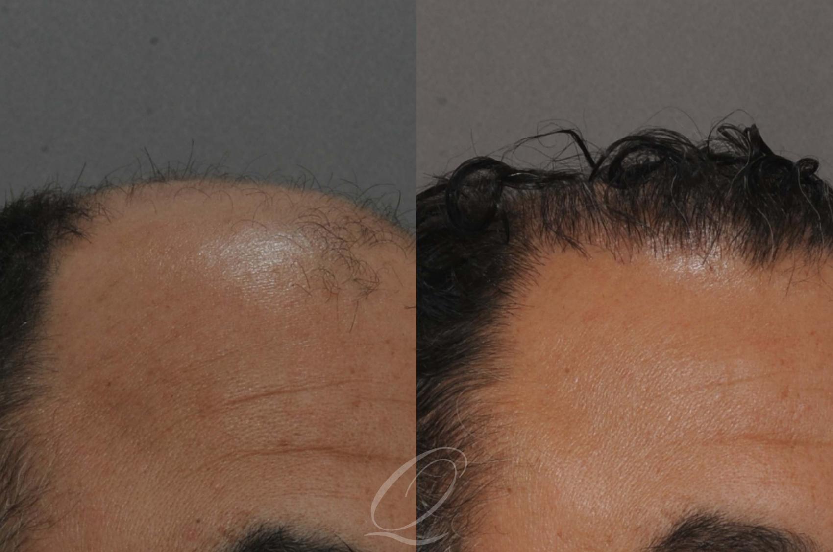 FUT Case 1011 Before & After View #2 | Rochester, Buffalo, & Syracuse, NY | Quatela Center for Hair Restoration