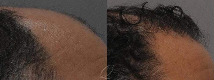Male Hairline and Central Density Hair Restoration Case 1011 Before & After View #3 | Serving Rochester, Syracuse & Buffalo, NY | Quatela Center for Plastic Surgery