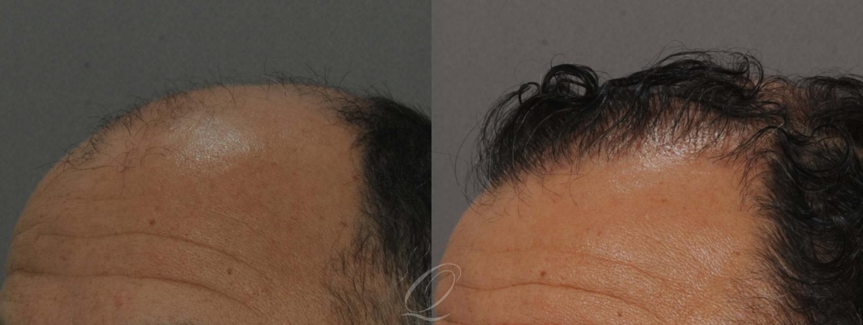 FUT Case 1011 Before & After View #4 | Rochester, NY | Quatela Center for Hair Restoration