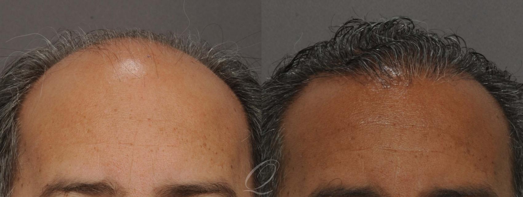 Male Hairline and Central Density Hair Restoration Case 1012 Before & After View #1 | Serving Rochester, Syracuse & Buffalo, NY | Quatela Center for Plastic Surgery