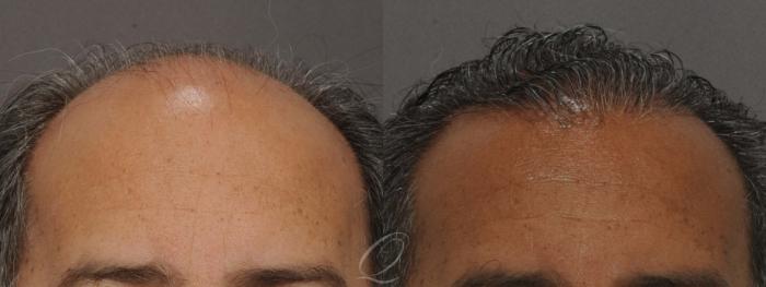 FUT Case 1012 Before & After View #1 | Rochester, Buffalo, & Syracuse, NY | Quatela Center for Hair Restoration