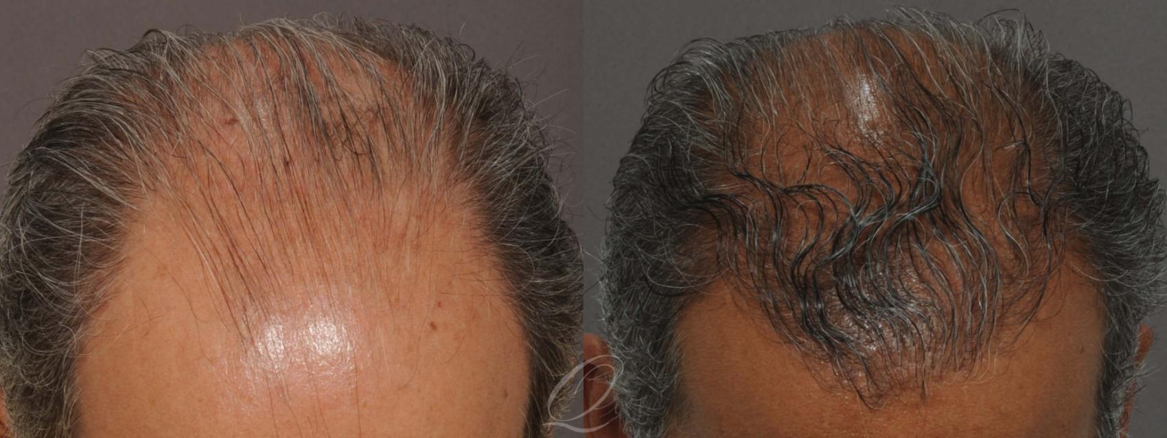FUT Case 1012 Before & After View #2 | Rochester, NY | Quatela Center for Hair Restoration