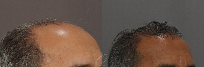FUT Case 1012 Before & After View #3 | Rochester, Buffalo, & Syracuse, NY | Quatela Center for Hair Restoration