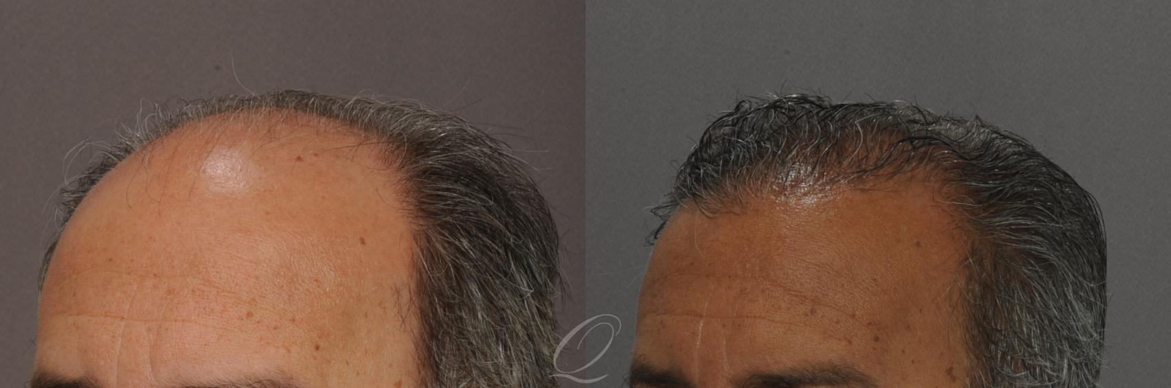 FUT Case 1012 Before & After View #4 | Rochester, NY | Quatela Center for Hair Restoration