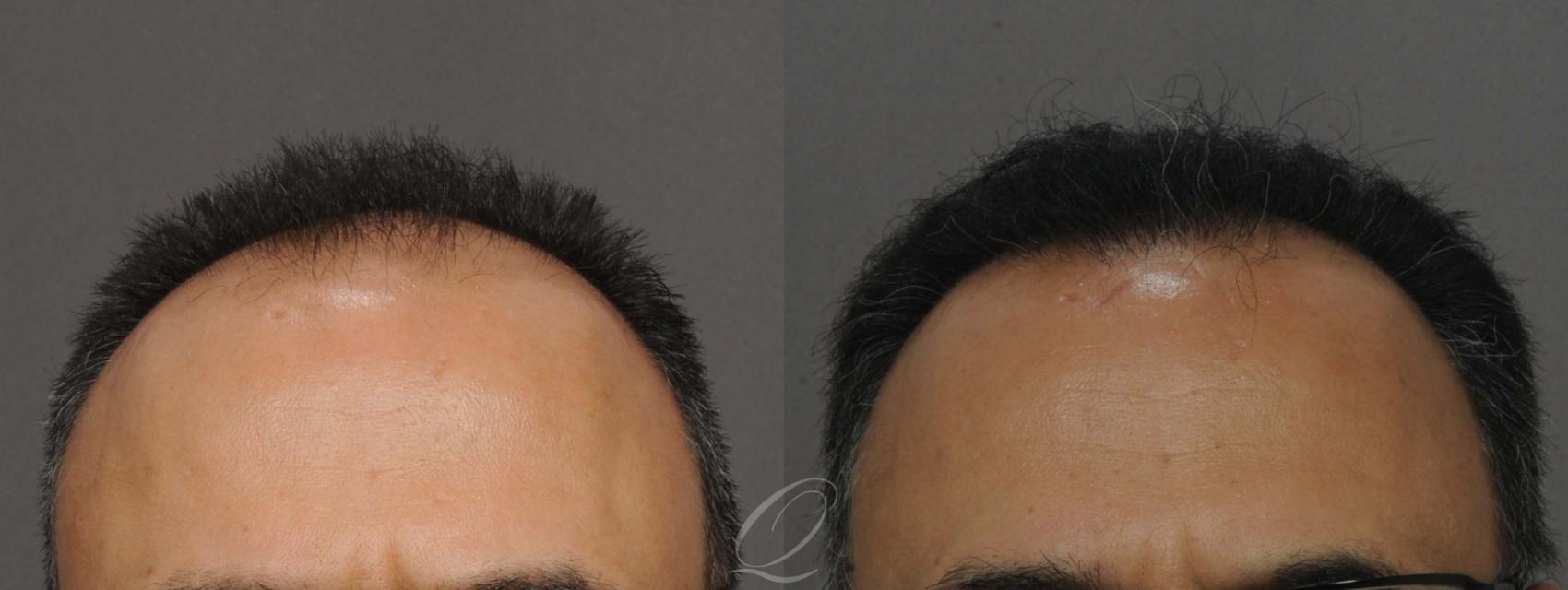 Male Hairline and Central Density Hair Restoration Case 1013 Before & After View #1 | Rochester, Buffalo, & Syracuse, NY | Quatela Center for Hair Restoration