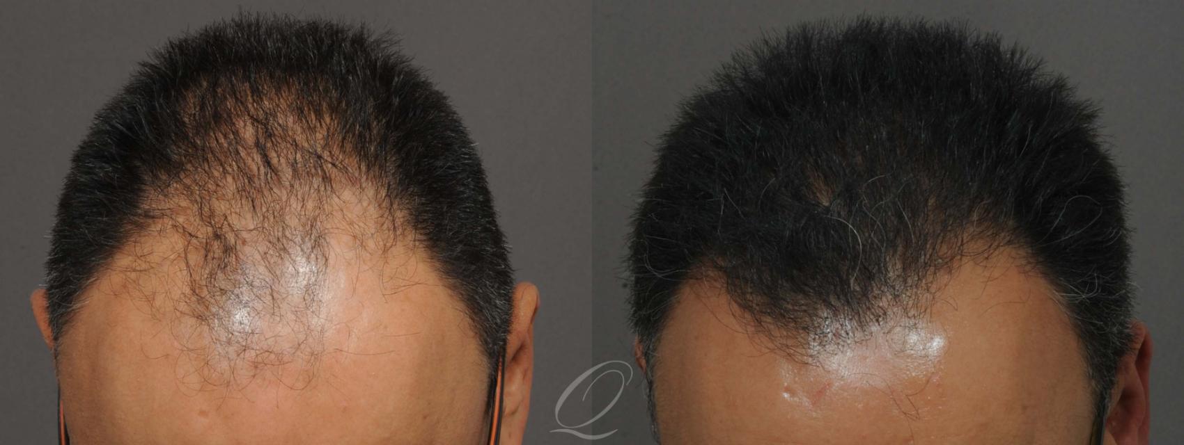 Male Hairline and Central Density Hair Restoration Case 1013 Before & After View #2 | Rochester, Buffalo, & Syracuse, NY | Quatela Center for Hair Restoration