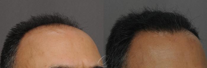 FUT Case 1013 Before & After View #3 | Rochester, Buffalo, & Syracuse, NY | Quatela Center for Hair Restoration
