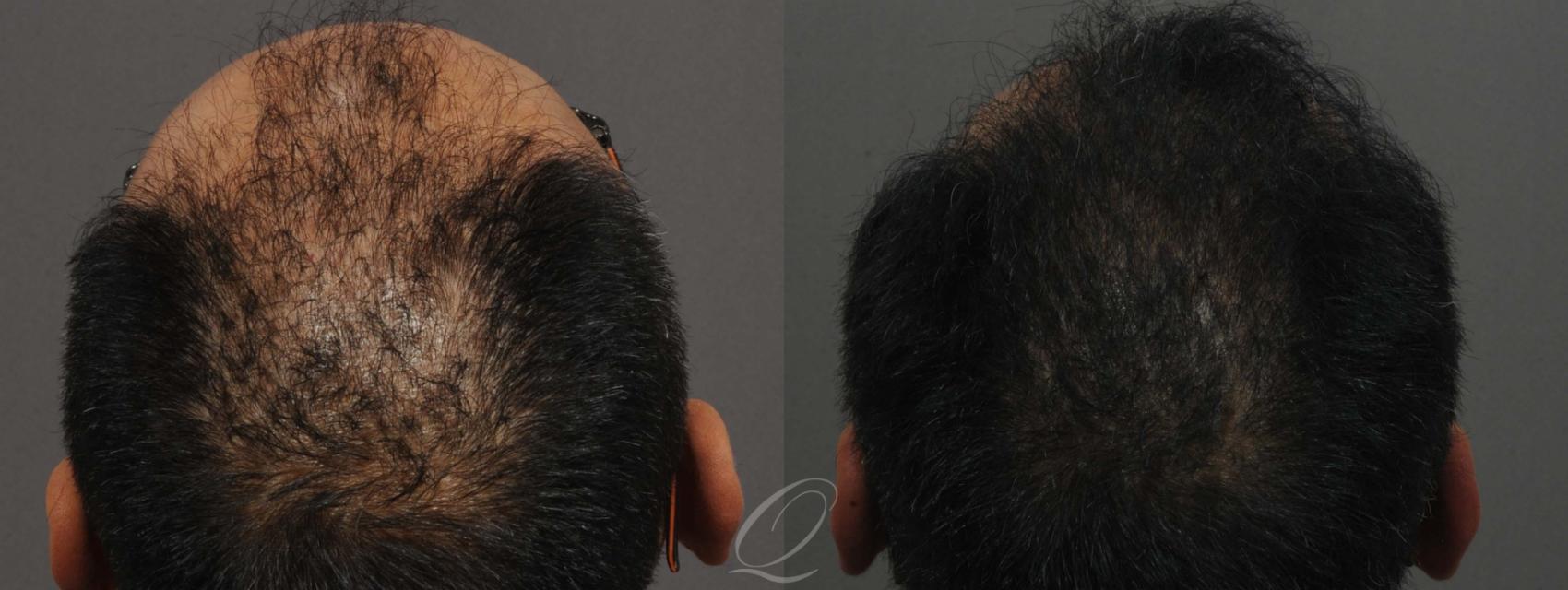 FUT Case 1013 Before & After View #4 | Rochester, NY | Quatela Center for Hair Restoration