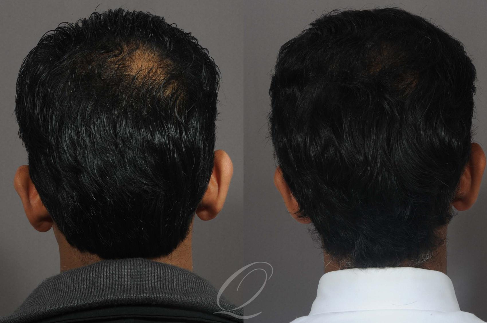Male Crown Hair Restoration Case 1014 Before & After View #1 | Rochester, Buffalo, & Syracuse, NY | Quatela Center for Hair Restoration