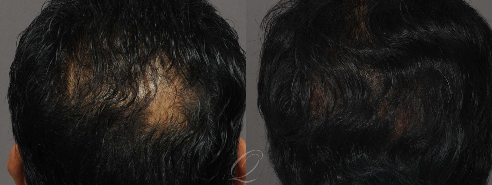 Male Crown Hair Restoration Case 1014 Before & After View #2 | Rochester, Buffalo, & Syracuse, NY | Quatela Center for Hair Restoration