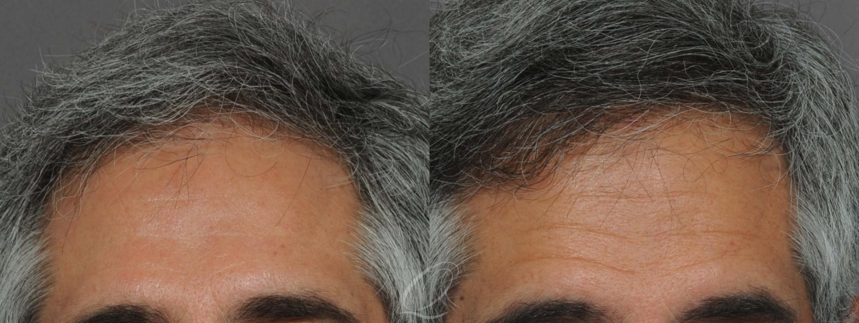 FUT Case 1015 Before & After View #1 | Rochester, Buffalo, & Syracuse, NY | Quatela Center for Hair Restoration