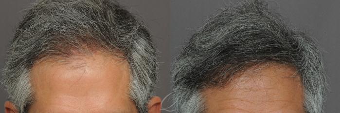 Male Hairline and Central Density Hair Restoration Case 1015 Before & After View #2 | Serving Rochester, Syracuse & Buffalo, NY | Quatela Center for Plastic Surgery