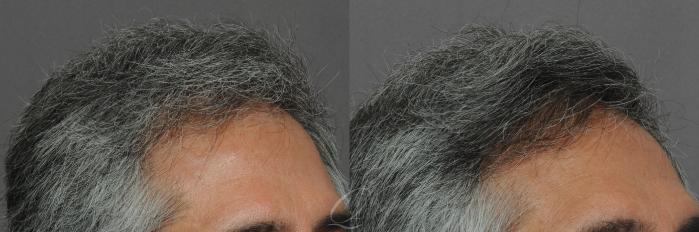 Male Hairline and Central Density Hair Restoration Case 1015 Before & After View #3 | Serving Rochester, Syracuse & Buffalo, NY | Quatela Center for Plastic Surgery