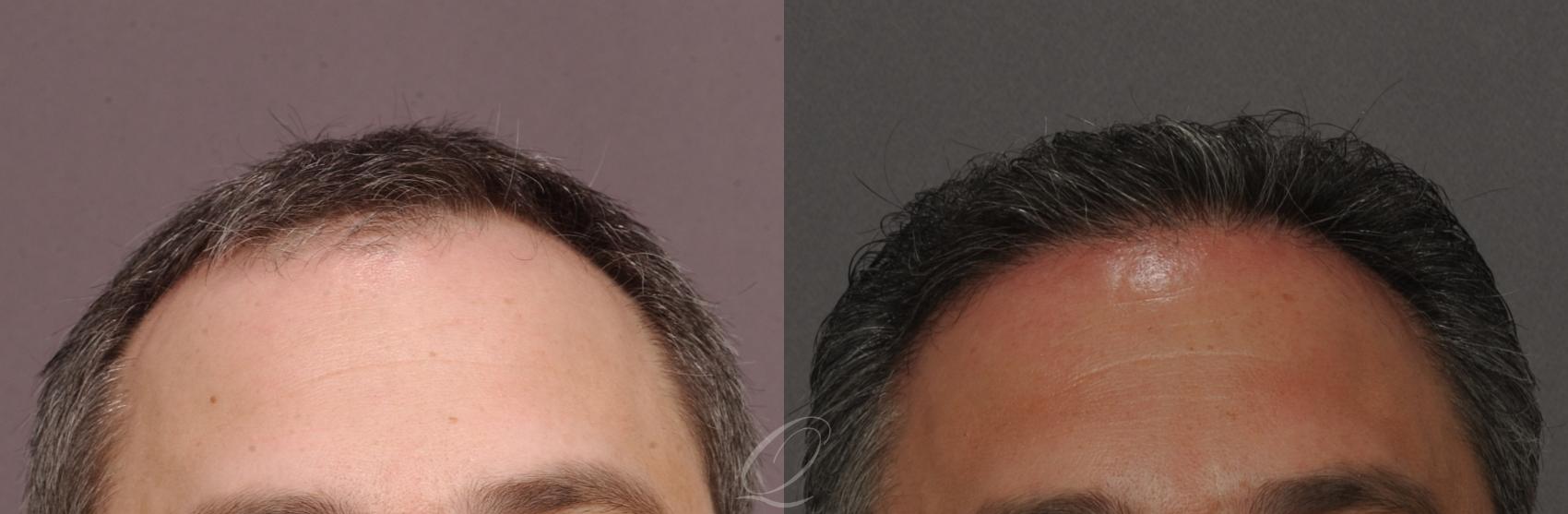 FUT Case 1016 Before & After View #1 | Serving Rochester, Syracuse & Buffalo, NY | Quatela Center for Plastic Surgery