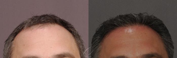 FUT Case 1016 Before & After View #1 | Rochester, Buffalo, & Syracuse, NY | Quatela Center for Hair Restoration