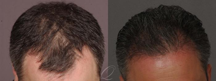 Before & After Male Hairline and Central Density Hair Restoration Case 1016 View #2 View in Rochester, Buffalo, & Syracuse, NY