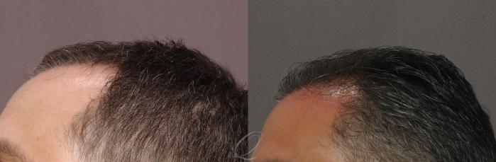 FUT Case 1016 Before & After View #3 | Rochester, Buffalo, & Syracuse, NY | Quatela Center for Hair Restoration