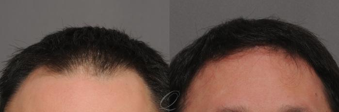 Male Hairline and Central Density Hair Restoration Case 1017 Before & After View #1 | Rochester, Buffalo, & Syracuse, NY | Quatela Center for Hair Restoration