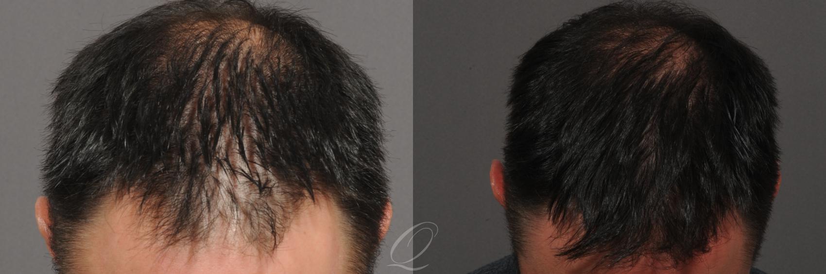 FUT Case 1017 Before & After View #2 | Rochester, NY | Quatela Center for Hair Restoration