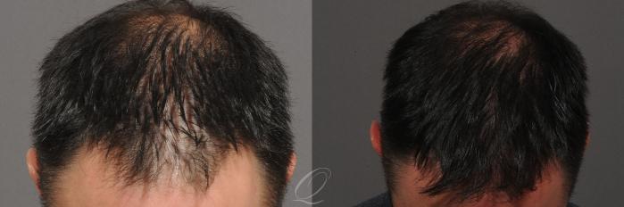 Male Hairline and Central Density Hair Restoration Case 1017 Before & After View #2 | Rochester, Buffalo, & Syracuse, NY | Quatela Center for Hair Restoration