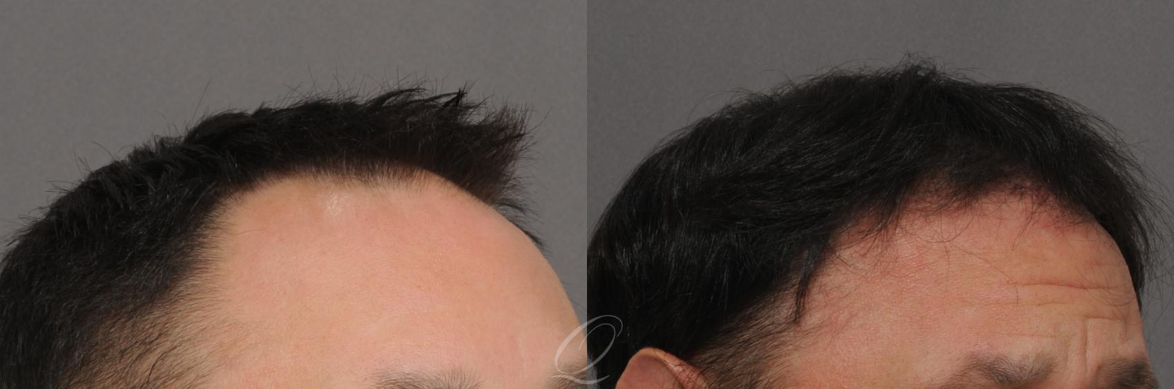 FUT Before & After Photos Patient 1017 | Rochester, Buffalo, & Syracuse, NY  | Quatela Center for Hair Restoration
