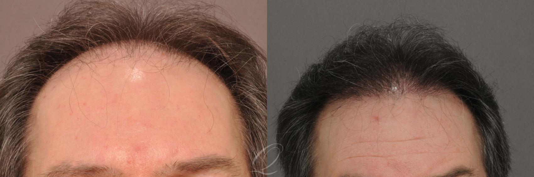 FUT Case 1018 Before & After View #1 | Rochester, Buffalo, & Syracuse, NY | Quatela Center for Hair Restoration
