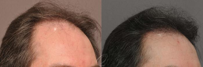 FUT Case 1018 Before & After View #2 | Rochester, Buffalo, & Syracuse, NY | Quatela Center for Hair Restoration