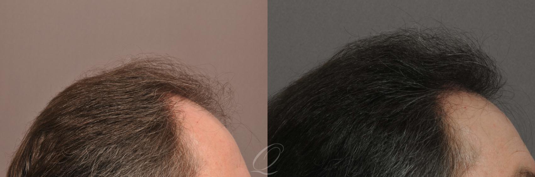 FUT Case 1018 Before & After View #3 | Rochester, NY | Quatela Center for Hair Restoration