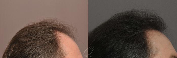 Male Hairline and Central Density Hair Restoration Case 1018 Before & After View #3 | Rochester, Buffalo, & Syracuse, NY | Quatela Center for Hair Restoration