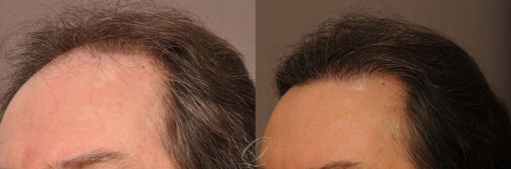 FUT Case 1018 Before & After View #4 | Rochester, NY | Quatela Center for Hair Restoration