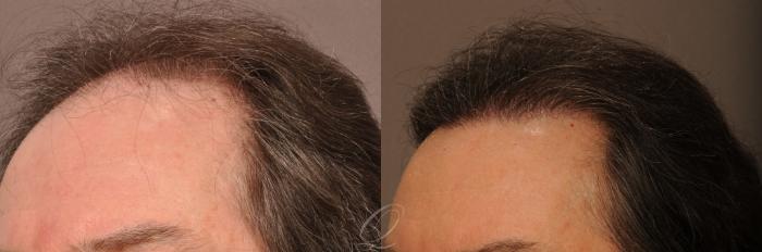 Male Hairline and Central Density Hair Restoration Case 1018 Before & After View #4 | Rochester, Buffalo, & Syracuse, NY | Quatela Center for Hair Restoration