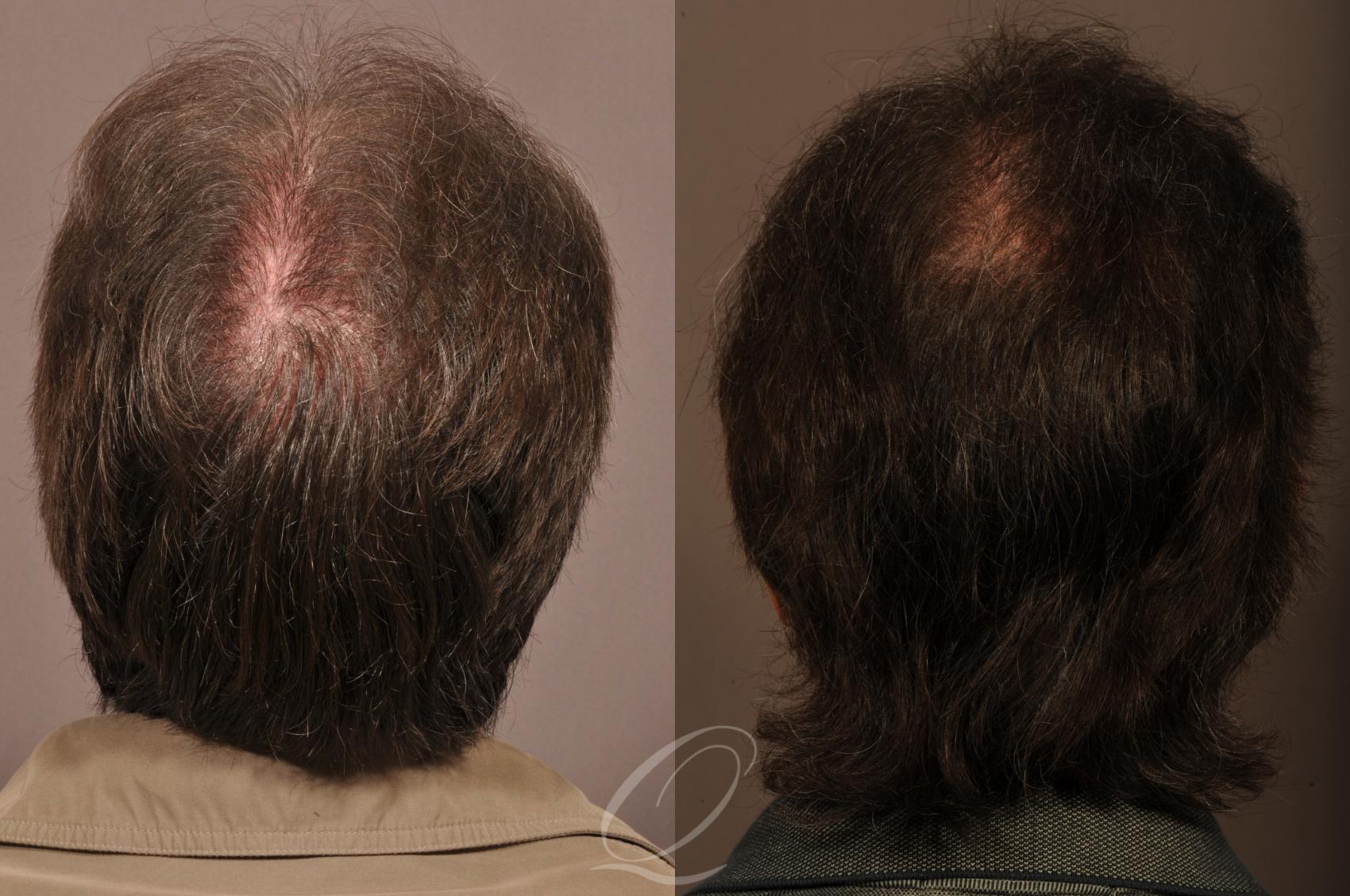 FUT Case 1018 Before & After View #5 | Rochester, Buffalo, & Syracuse, NY | Quatela Center for Hair Restoration