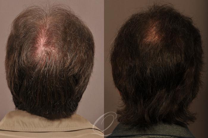 Male Hairline and Central Density Hair Restoration Case 1018 Before & After View #5 | Rochester, Buffalo, & Syracuse, NY | Quatela Center for Hair Restoration