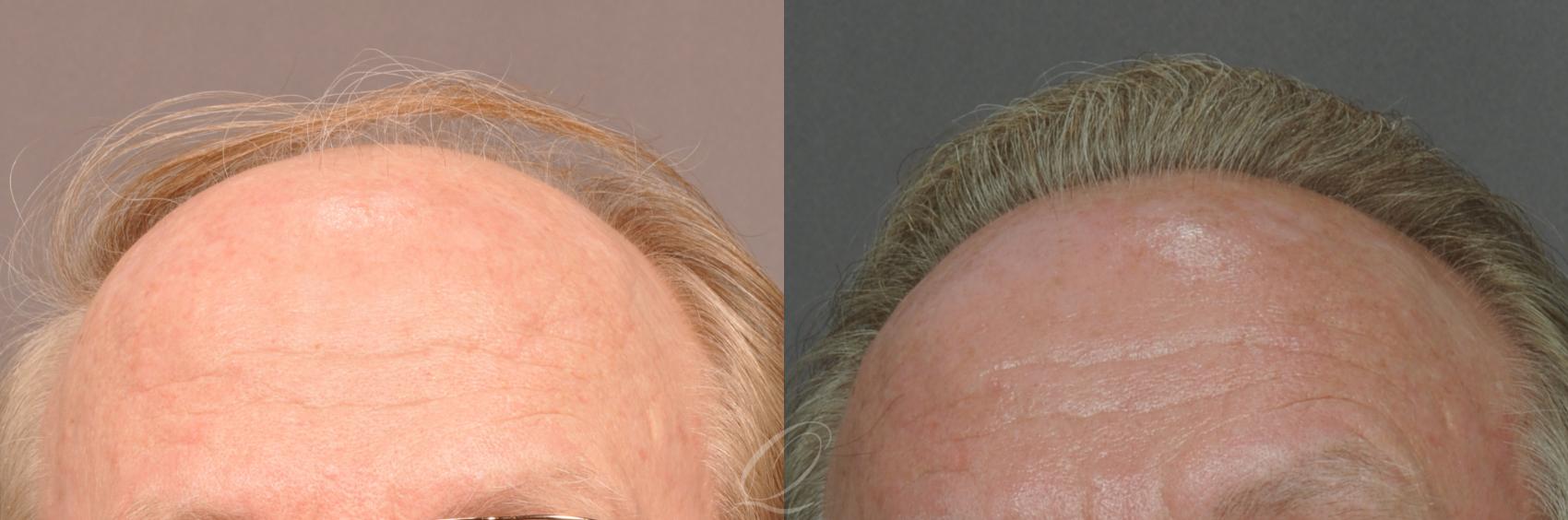 FUT Case 1019 Before & After View #1 | Rochester, NY | Quatela Center for Hair Restoration