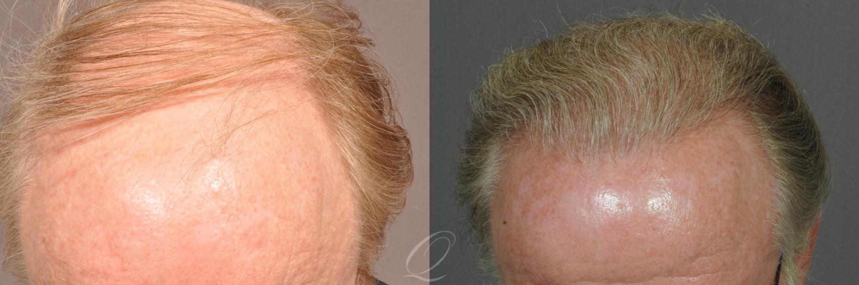 FUT Case 1019 Before & After View #2 | Rochester, NY | Quatela Center for Hair Restoration