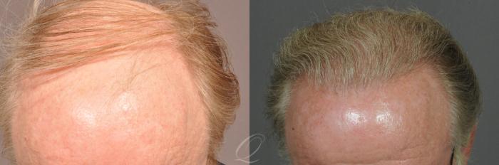 FUT Case 1019 Before & After View #2 | Rochester, Buffalo, & Syracuse, NY | Quatela Center for Hair Restoration