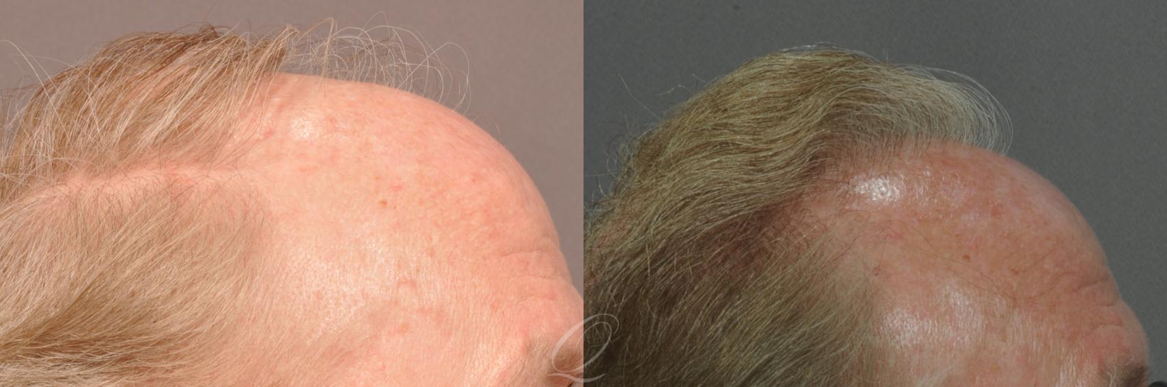 FUT Case 1019 Before & After View #3 | Rochester, Buffalo, & Syracuse, NY | Quatela Center for Hair Restoration