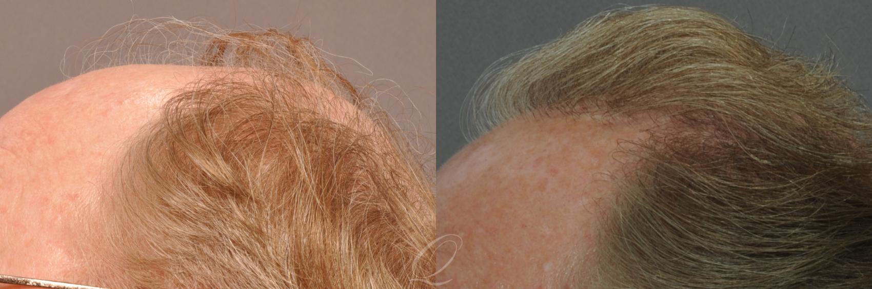 FUT Case 1019 Before & After View #4 | Rochester, NY | Quatela Center for Hair Restoration
