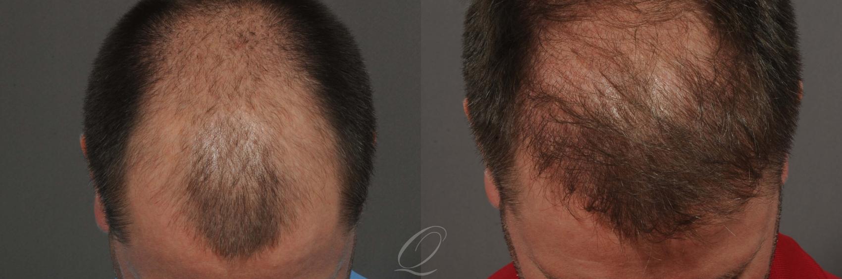 Male Hairline and Central Density Hair Restoration Case 1020 Before & After View #1 | Serving Rochester, Syracuse & Buffalo, NY | Quatela Center for Plastic Surgery